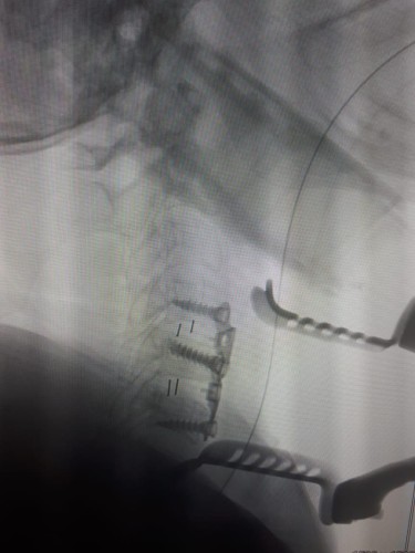 تدخل جراحي ناجح ينهي معاناة سيدة من الانزلاق الغظروفي بحفرالباطن