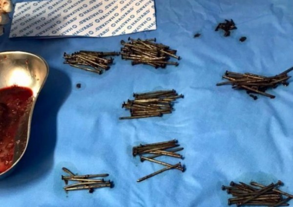 فريق طبي في مستشفى بـ”جدة” ينقذ مريض ويستخرج 230 مسمار وقطع زجاج من بطنه – صور
