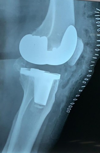 نجاح ثاني عملية استبدال مفصل ركبة مريضة في وادي الدواسر