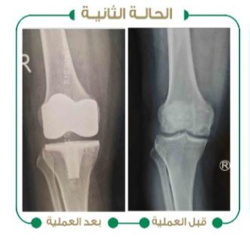 ‏نجاح عمليتين لإستبدال مفصل الركبة في “مستشفى وادي الدواسر”