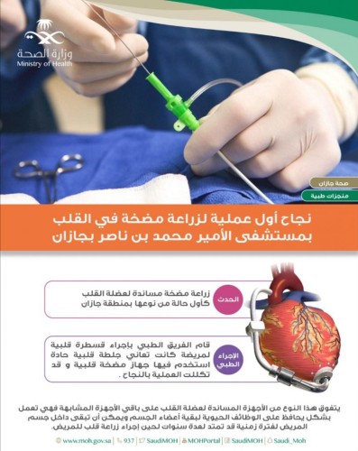فريق طبي بمستشفى الأمير محمد بن ناصر بجازان يتمكن من زراعة مضخة مساندة لعضلة القلب لمريضة ستينية