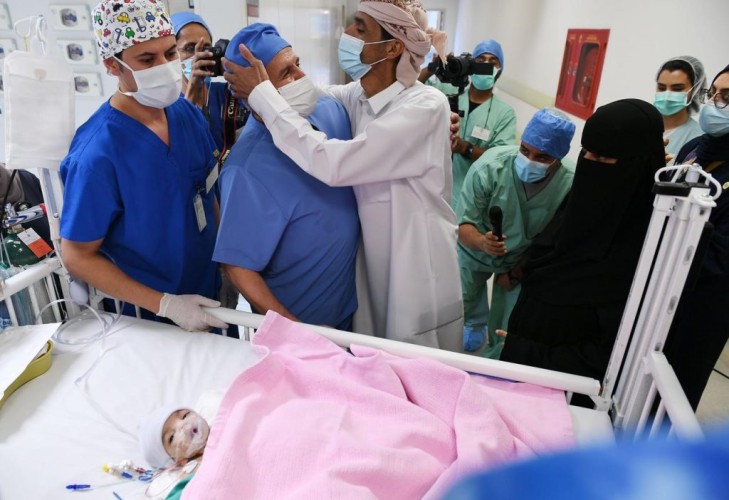الدكتور الربيعة يعلن نجاح عملية فصل التوأم الطفيلي اليمني عائشة