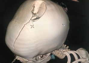 فريق طبي ينجح بترميم كسر جمجمة طفلة في وادي الدواسر