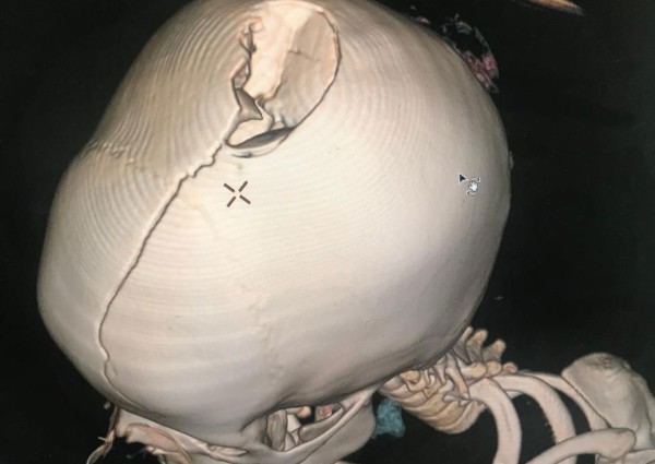 فريق طبي ينجح بترميم كسر جمجمة طفلة في وادي الدواسر
