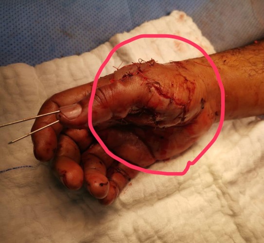 إعادة أصبع مريض باستخدام المجهر الجراحي بـ”سعود الطبية”