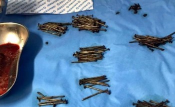 فريق طبي في مستشفى بـ”جدة” ينقذ مريض ويستخرج 230 مسمار وقطع زجاج من بطنه – صور فريق طبي في مستشفى بـ”جدة” ينقذ مريض ويستخرج 230 مسمار وقطع زجاج من بطنه – صور