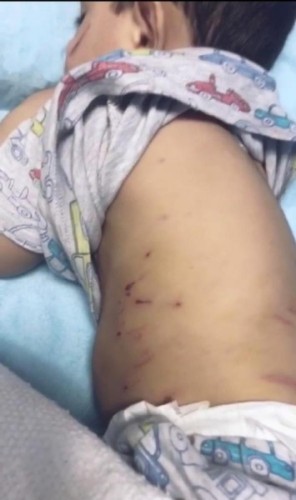 هجوم شرس لكلاب ضالة على طفل بالأحساء .. والأمانة تعلن عن تحرك عاجل