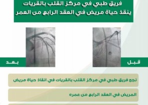 فريق طبي في مركز القلب بالقريات ينقذ حياة مريض في العقد الرابع من العمر