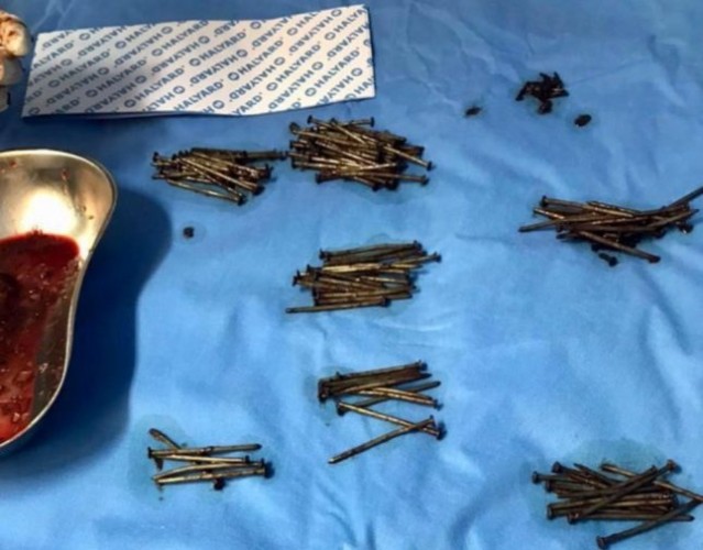 فريق طبي في مستشفى بـ”جدة” ينقذ مريض ويستخرج 230 مسمار وقطع زجاج من بطنه – صور
